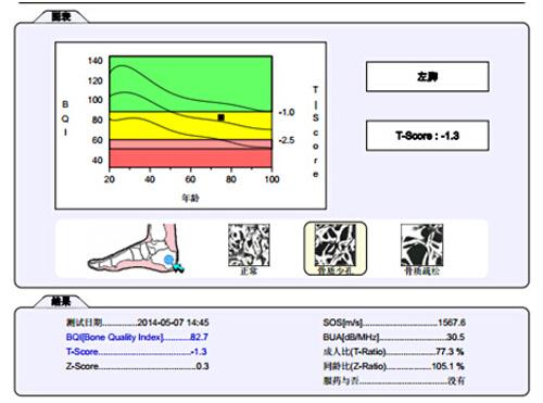 骨密度測量結(jié)果.jpg