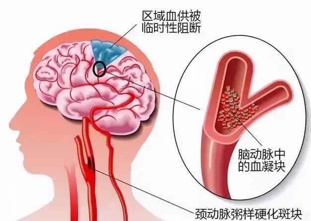 經(jīng)顱多普勒儀器廠(chǎng)家?guī)私饽X動(dòng)脈硬化的臨床表現(xiàn)