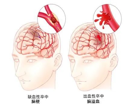 心腦血管疾病應該做哪些檢查? 經顱多普勒血流分析儀超聲檢查